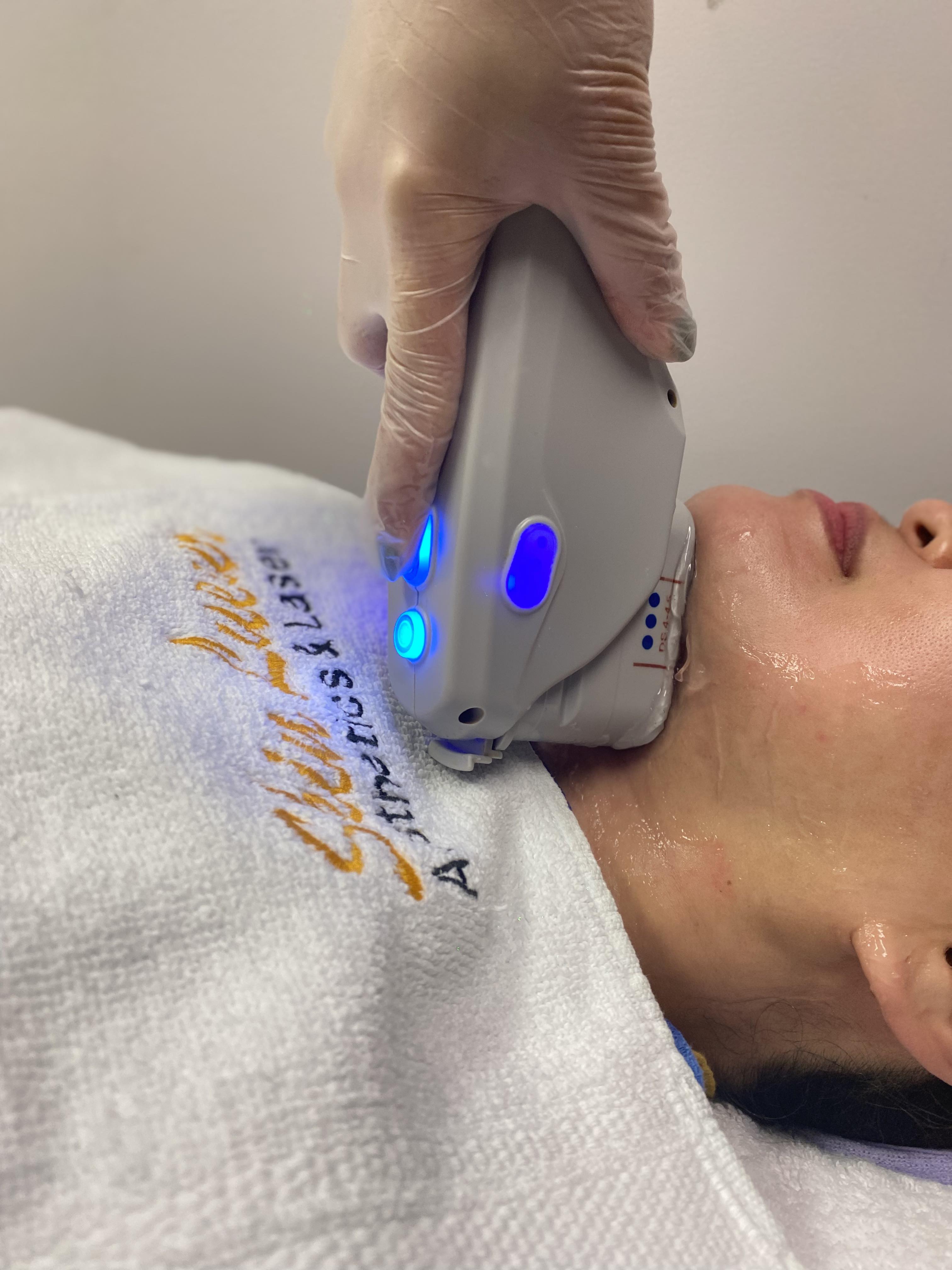 HiFu (High Focused Ultrasound for Facial Contouring)